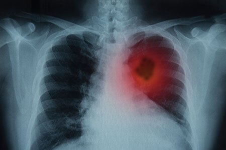 diagnosis of lung cancer