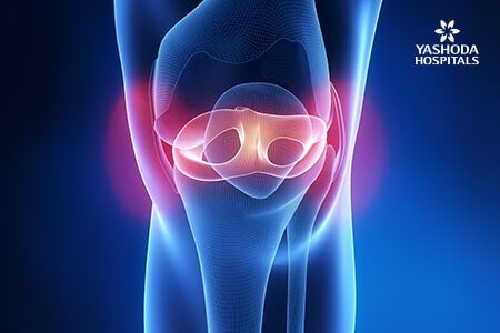 Discoid Meniscus Causes