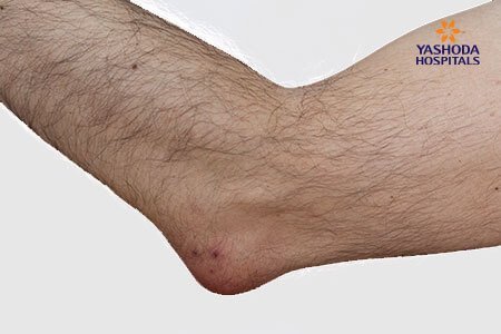 Elbow (Olecranon) Bursitis: What is Elbow (Olecranon) Bursitis, its Causes?