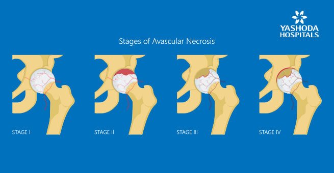 femoral head loose its blood supply