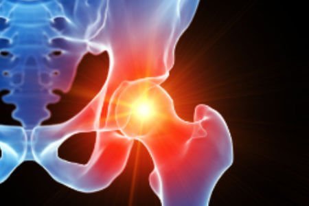 Symptoms, Risk Factors and Complications of Femoroacetabular Impingement