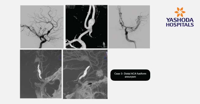 Flow Diverter Stents