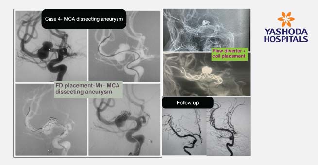 Flow Diverter Stents