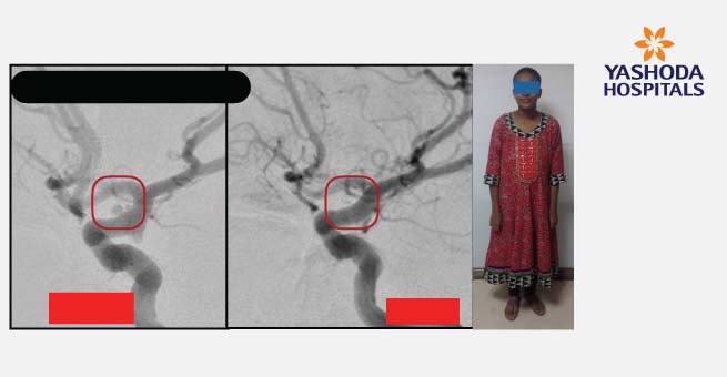 Flow Diverter Stents