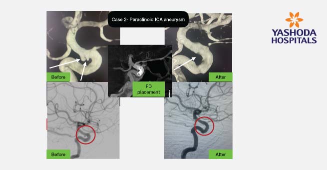 Flow Diverter Stents