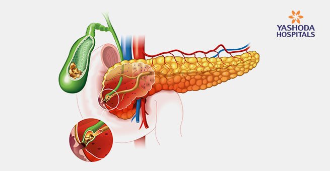 Gallstones