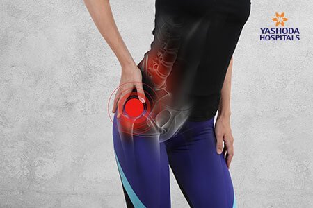 Hip Arthritis causes