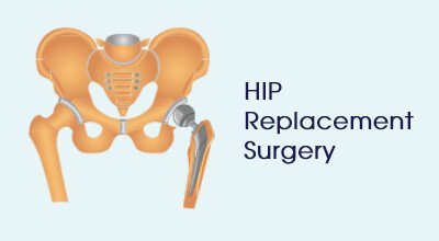 Hip Replacement Surgery