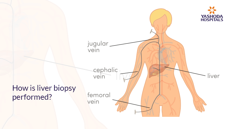 How is liver biopsy performed