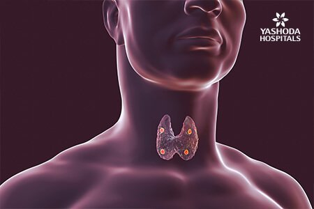 Hyperparathyroidism: What is Hyperparathyroidism, its Causes?