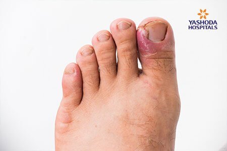 Ingrown Toenail: What is Ingrown Toenail, its Causes?