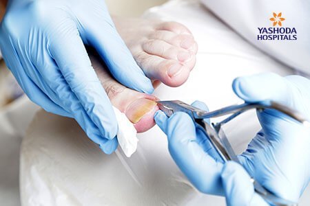 Ingrown Toenail: Diagnosis, Prevention and Treatment