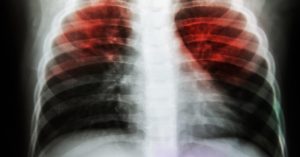 Interstitial lung disease