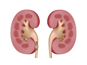 types of kidney stones