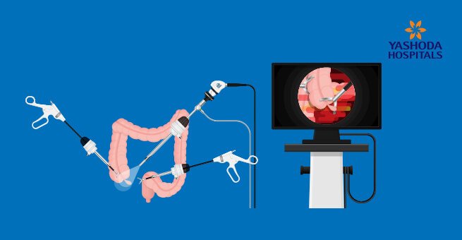 Laparoscopic Appendix Removal Surgery