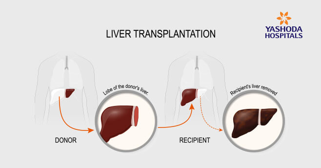 Liver Transplantation