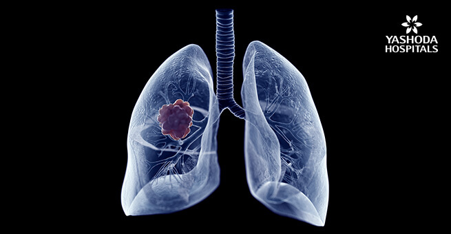 Lung cancer