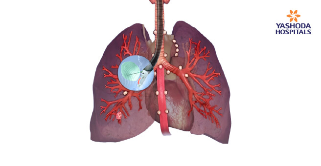 Mediastinal-lymphadenopathy2