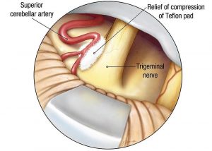 Microvascular decompression for Trigeminal Neuralgia