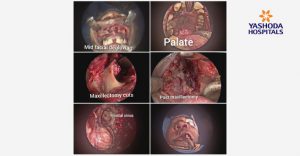 Mucormycosis Come From