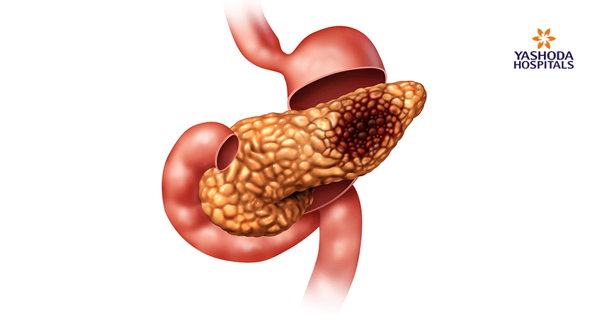 Pancreatic neuroendocrine carcinoma