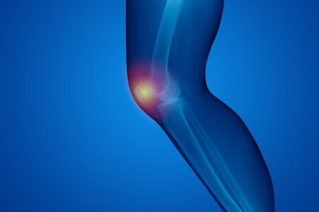 Patellofemoral Arthritis: Symptoms and Complications