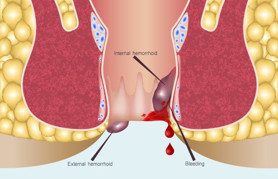 Piles Surgery Cost in India | Piles Surgery Cost in Hyderabad