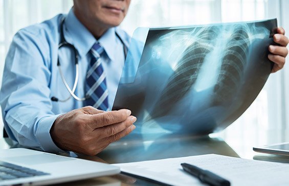 Pneumonectomy Cost in India | Pneumonectomy Cost in Hyderabad