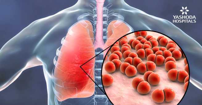 Pneumonia in covid19