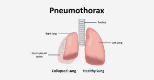 Pneumothorax