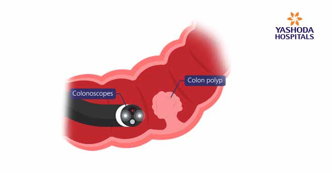 Polypectomy and local excision