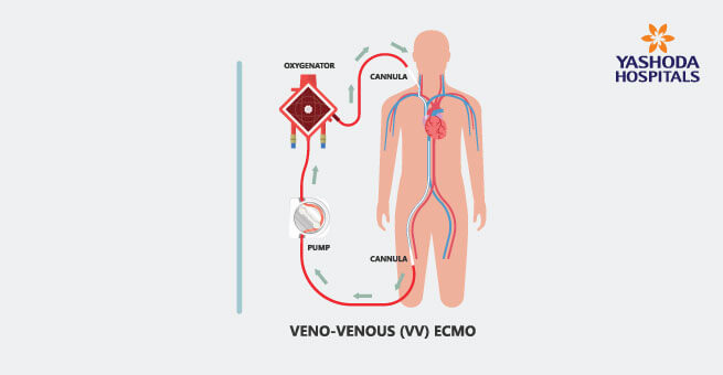 Venovenous (VV) ECMO