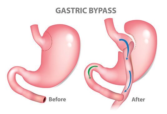  Bariatric surgery cost in Hyderabad