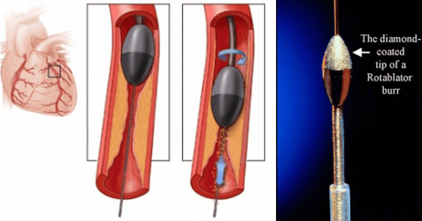 A special catheter, with an acorn-shaped, diamond-coated tip, is guided to the point of narrowing in your coronary artery. The tip spins around at a high speed and grinds away the plaque on your artery walls