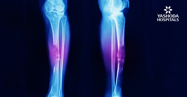 Anteroposterior lateral leg xray showing advanced