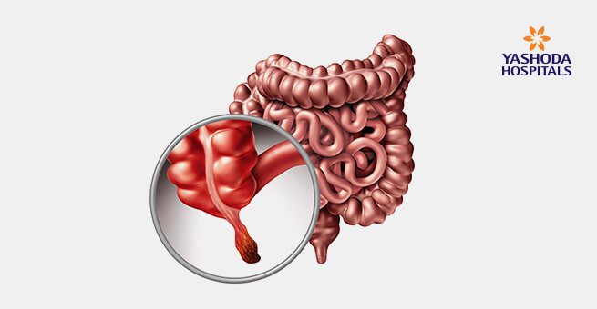 appendicitis surgery in yashoda