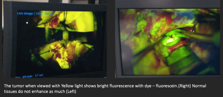 brain tumor contrast mri