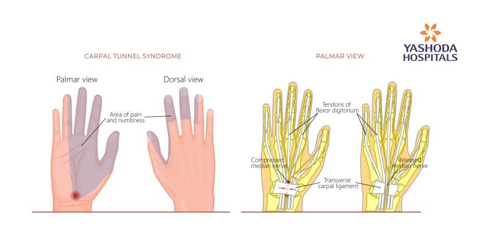 endoscopic surgery carpel tunnel release