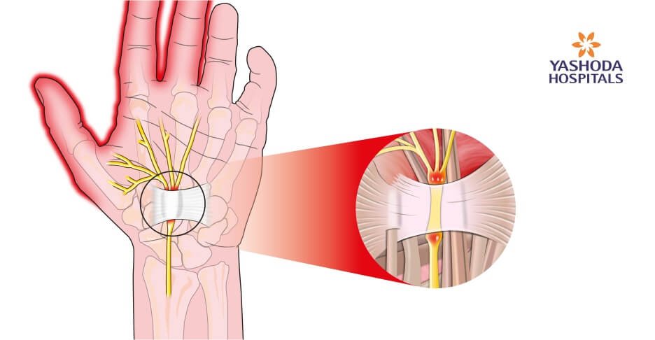 endoscopic surgery carpel tunnel release