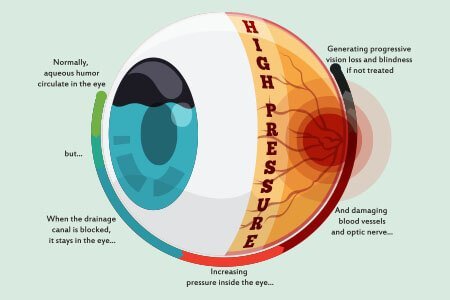 causes of glaucoma