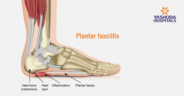 causes of heel pain