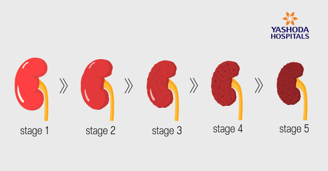 Chronic Kidney Disease