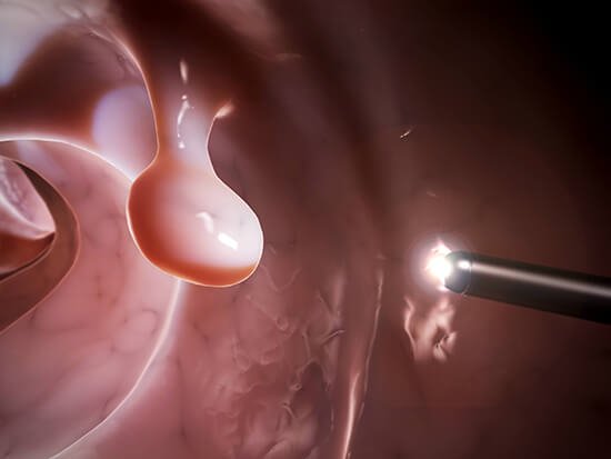 colon cancer-colonoscopy