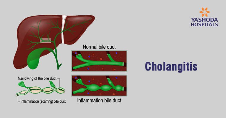 What are the complications of biliary atresia