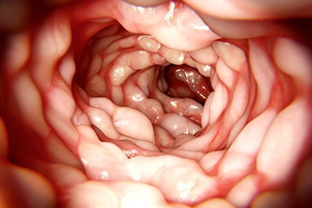 diagnosis of Inflammatory Bowel Disease, Ulcerative Colitis and Crohn’s Disease