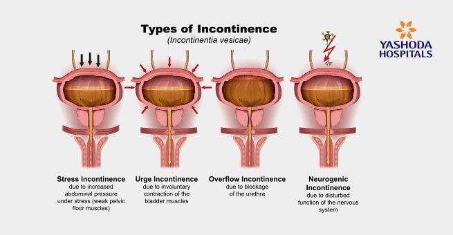 different types of urinary incontinence