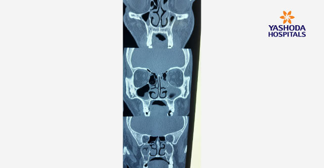 early signs and symptoms for Mucormycosis disease