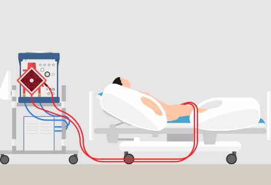 ECMO Treatment Cost in Hyderabad