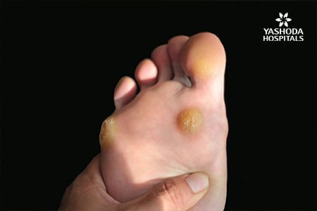 Foot Corn: Symptoms and Complications