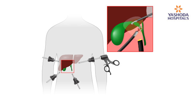 gallstones-with-laparoscopic-cholecystectomy2